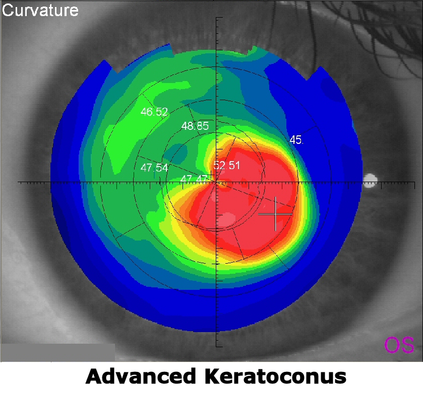 Scleral Contact lens for Keratoconus Treatment